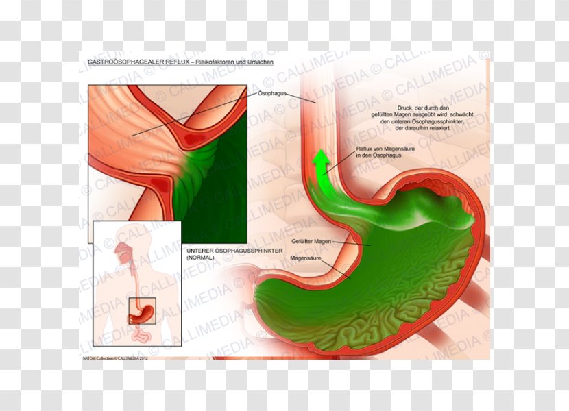 Gastroesophageal Reflux Disease Gastroenterology Gastroenteritis Pathology - Sphincter - Esophagus Transparent PNG