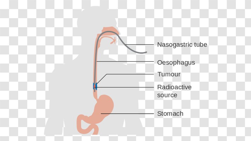 Esophagus Esophageal Cancer Dysphagia Esophagectomy - Watercolor Transparent PNG