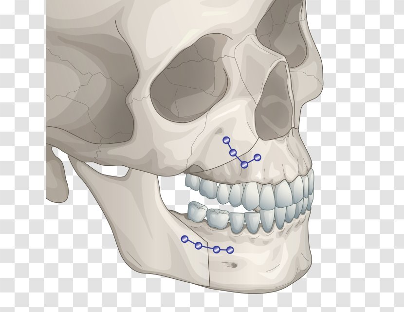 Jaw Orthognathic Surgery Chin Plastic - Facial Skeleton - Face Transparent PNG