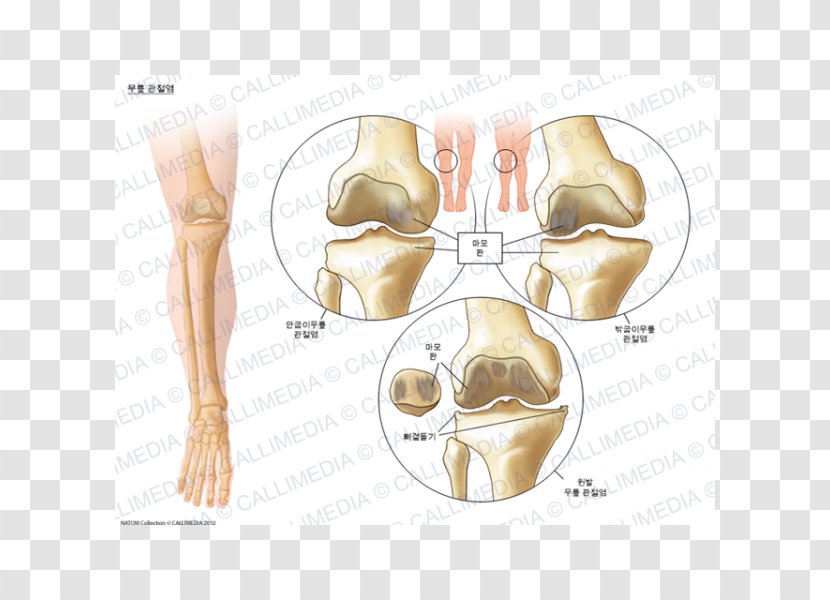 Knee Arthritis Osteoarthritis Pain - Frame - Ráº¯n 3d Transparent PNG