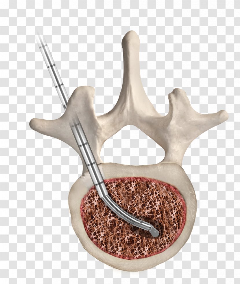 Thoracic Vertebrae Human Vertebral Column Percutaneous Vertebroplasty - Bone - Antler Transparent PNG