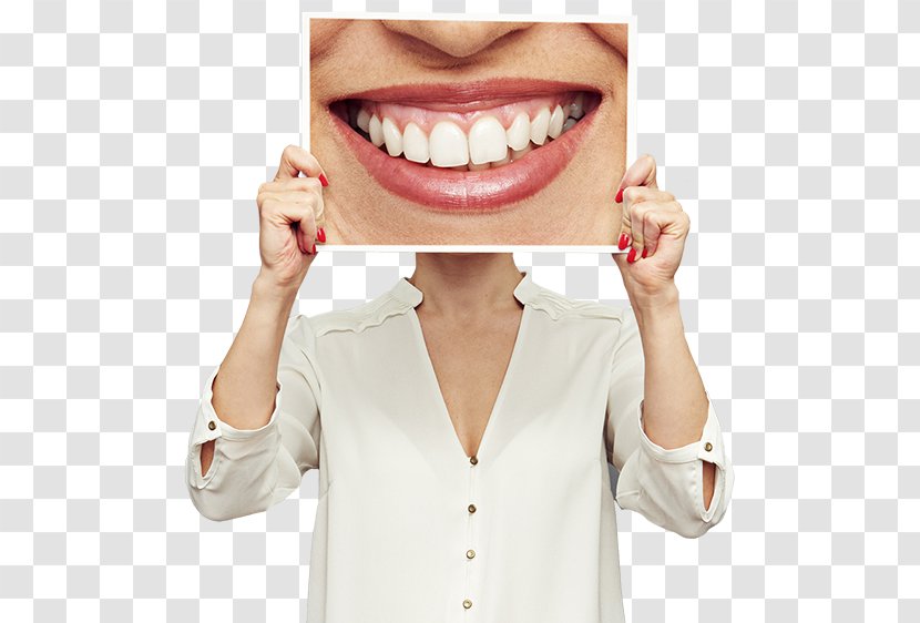 Cosmetic Dentistry Veneer Dental Implant - Human Tooth - Crown Transparent PNG