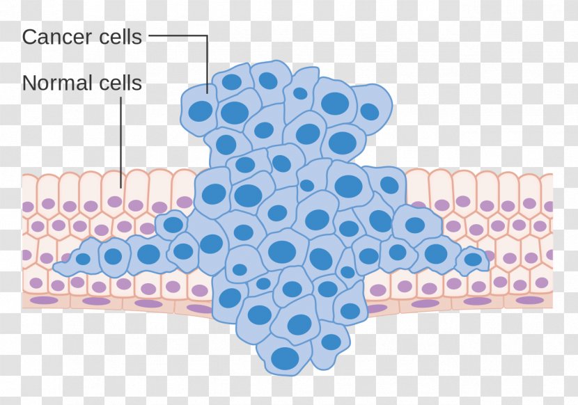 Cancer Cell Metastasis Neoplasm - Growth - Various Cells Transparent PNG