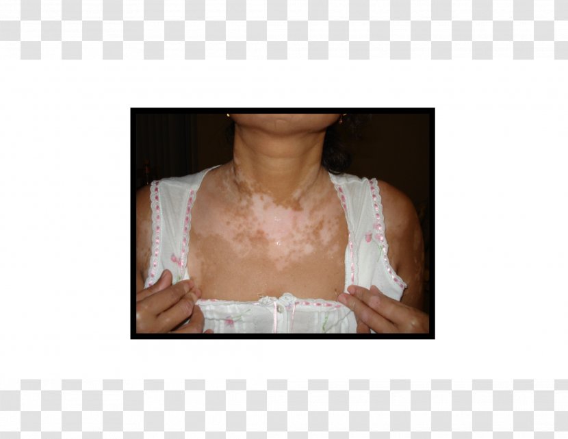 Vitiligo Disease Skin Therapy Health - Tree Transparent PNG
