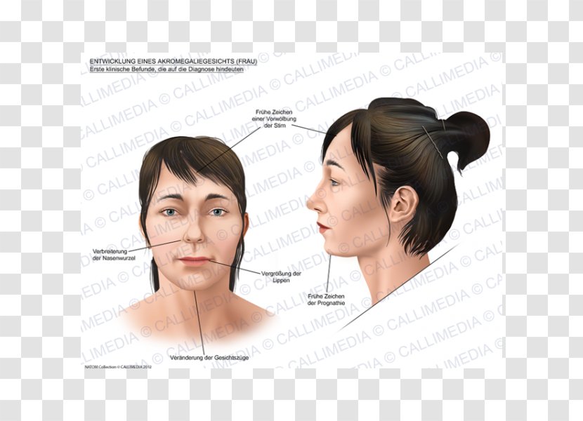 Acromegaly Face Skull Bossing Gigantism Symptom - Eyebrow Transparent PNG