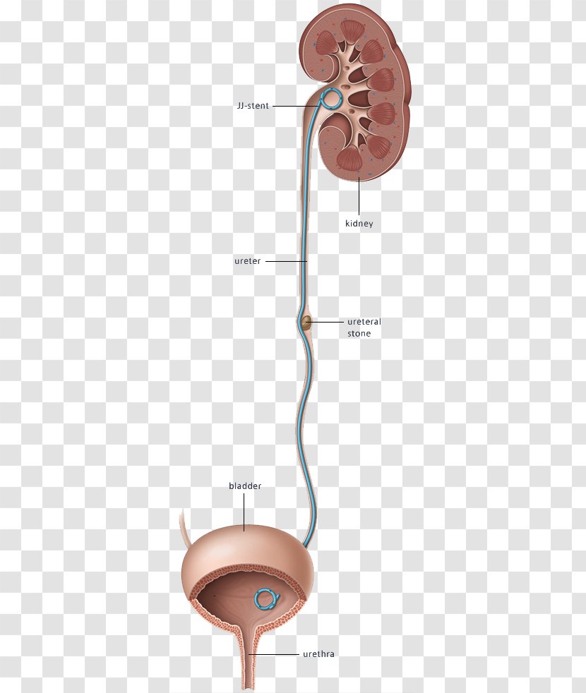 Ureteric Stent Stenting Excretory System Kidney - Frame - Stones Transparent PNG