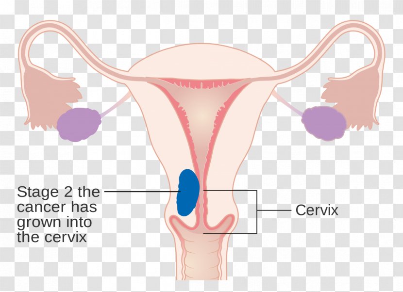 Endometrial Cancer Uterus Staging Ovarian - Tree - Cervical Transparent PNG
