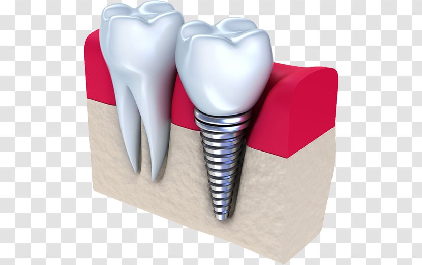 Dental Implant Dentistry Tooth - Cartoon - Crown Transparent PNG