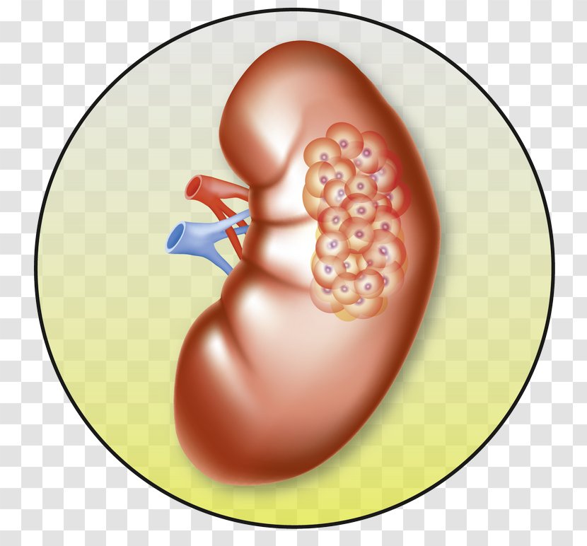 Kidney Cancer Tumour Renal Cell Carcinoma - Frame Transparent PNG