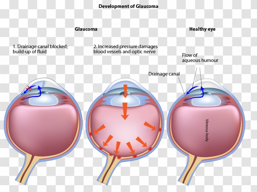 Glaucoma Laser Surgery Eye Disease Ophthalmology - Frame - Aqueous Transparent PNG