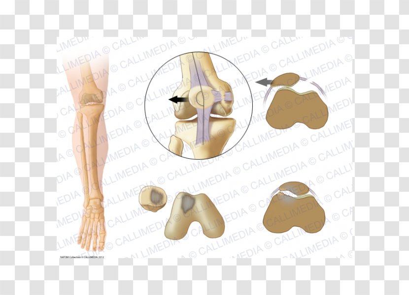 Shoulder Patella Bone Subluxation Joint Dislocation - Heart - 360 Degrees Transparent PNG
