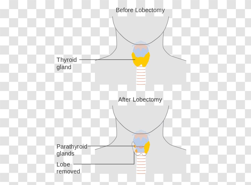 Thyroidectomy Lobectomy Surgery Thyroid Cancer - Tree Transparent PNG