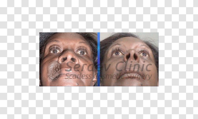 Snout Serdev Suture Surgical Nose Cheek - Lip Transparent PNG