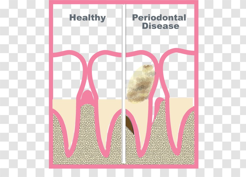 Periodontology Periodontal Disease Periodontium Gums Tooth - Watercolor - Silhouette Transparent PNG