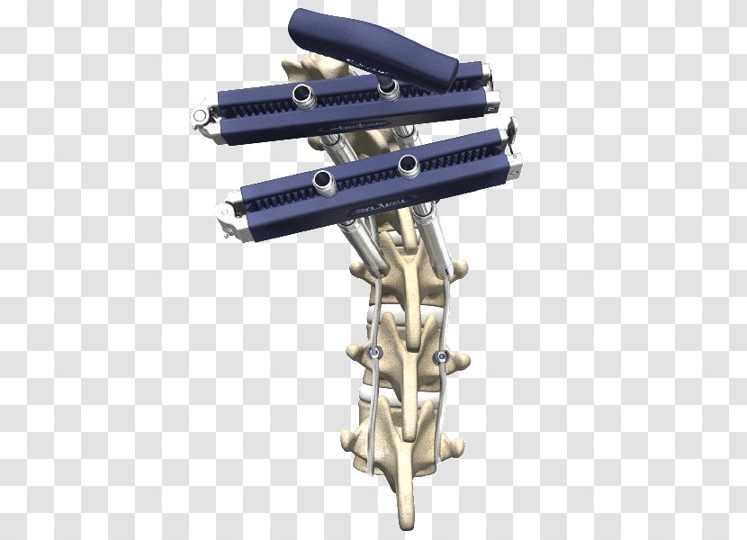 Vertebral Column Surgery Spinal Fusion Stryker Corporation - Health - Tool Transparent PNG