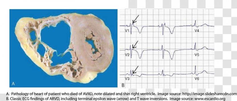 Arrhythmogenic Right Ventricular Dysplasia Hypertrophic Cardiomyopathy Dilated Naxos Syndrome - Cartoon - Heart Transparent PNG