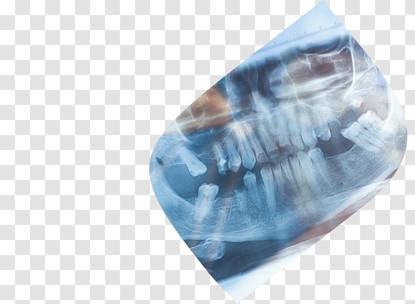 Dentistry Tooth Dental Implant Orthodontics - Wisdom - Orthodontist Transparent PNG
