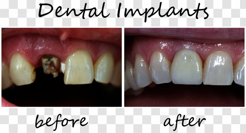 Tooth Dental Implant Prosthetics Dentistry - Flower - Smile Transparent PNG