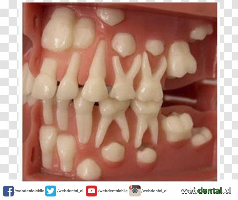 Tooth Eruption Deciduous Teeth Permanent Human - Lip - Child Transparent PNG