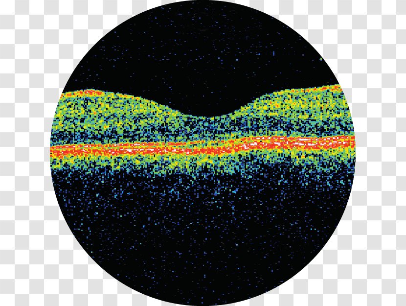 Astha Hospital Optical Coherence Tomography Critical Appraisal Medicine - Eye - Playlist Transparent PNG