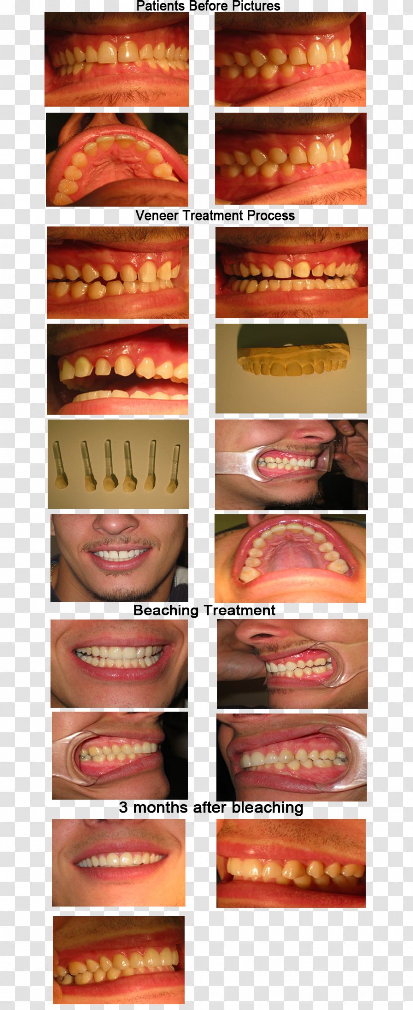 Veneer Dentistry Dental Porcelain Tooth - Veneers Transparent PNG