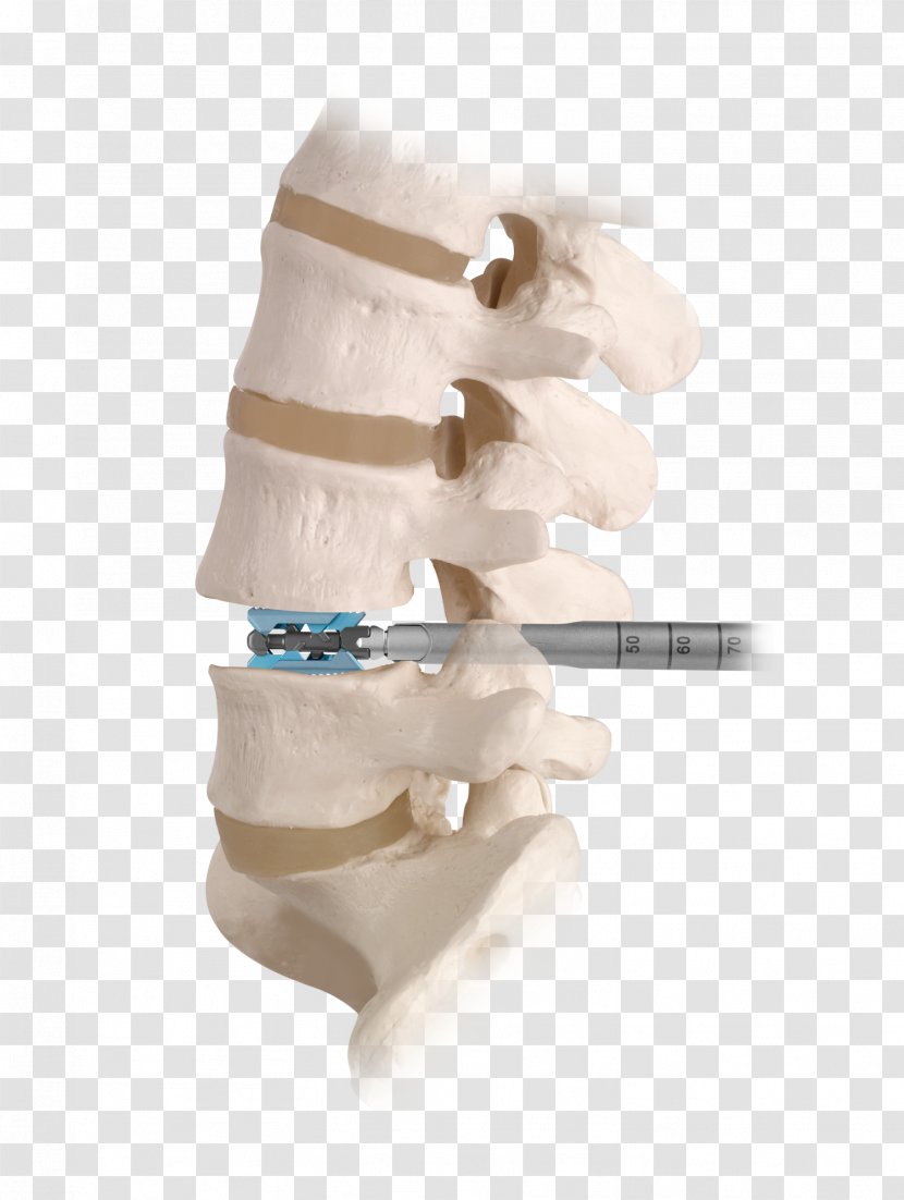 Spinal Fusion Vertebral Column Decompression Human Back Lumbar - Discectomy - Low Pain Transparent PNG