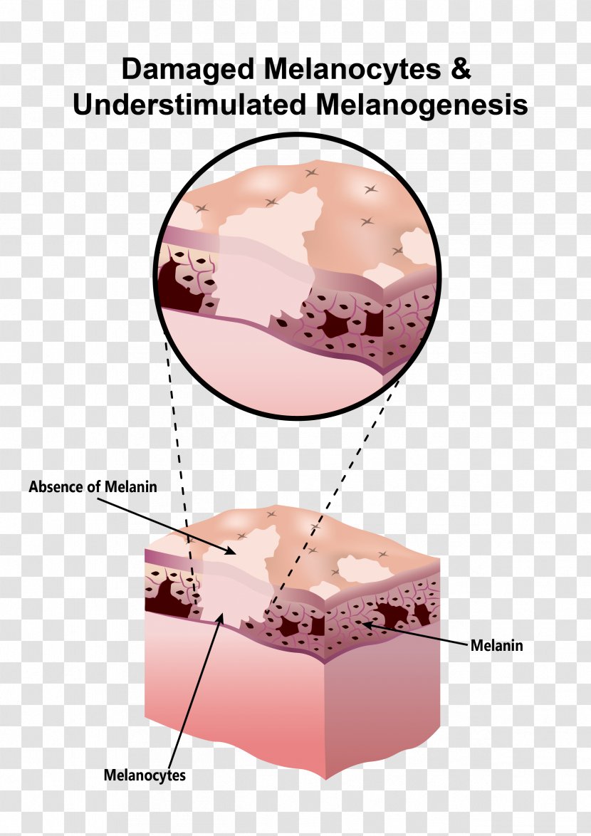 Melanocyte Melanin Scar Hypopigmentation Skin - Tissue Cells Transparent PNG