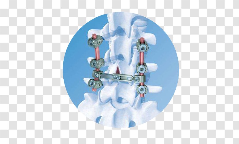 Vertebral Column DePuy Synthes Companies Osteosynthesis Spinal Cord Vertical Expandable Prosthetic Titanium Rib - Bone Screw Transparent PNG
