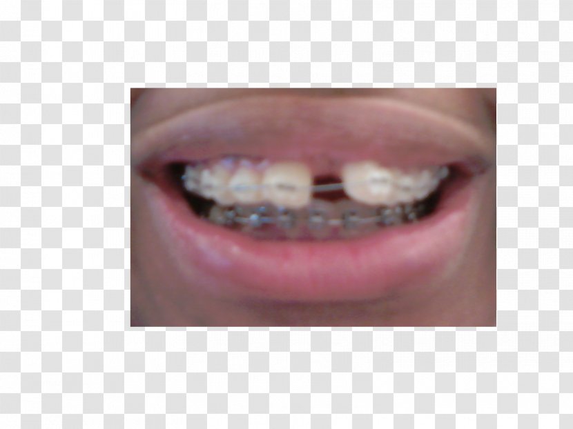 Close-up - Tooth - Braces Transparent PNG