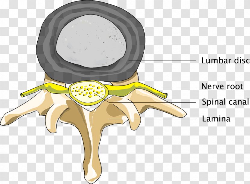 Spinal Disc Herniation Back Pain Stenosis Medical Diagnosis Vertebral Column - Watercolor Transparent PNG