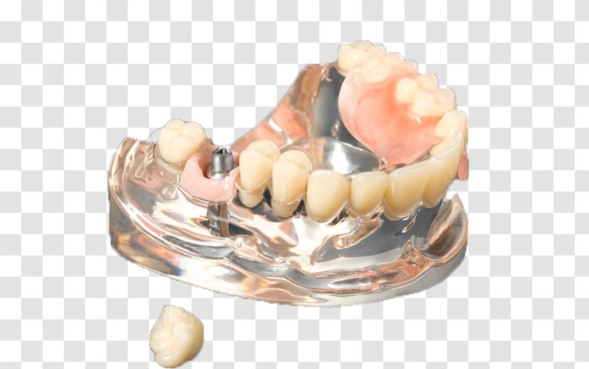 Medic Company Limited Crown Business Tooth Dental Implant - Jaw Transparent PNG
