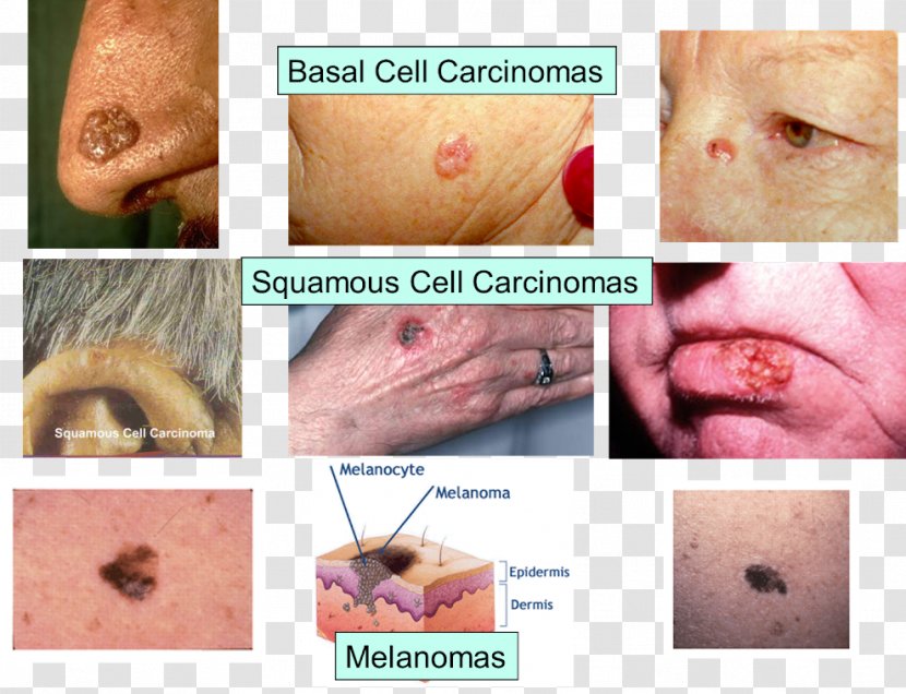 Skin Cancer Melanoma Lymph Node - Frame Transparent PNG