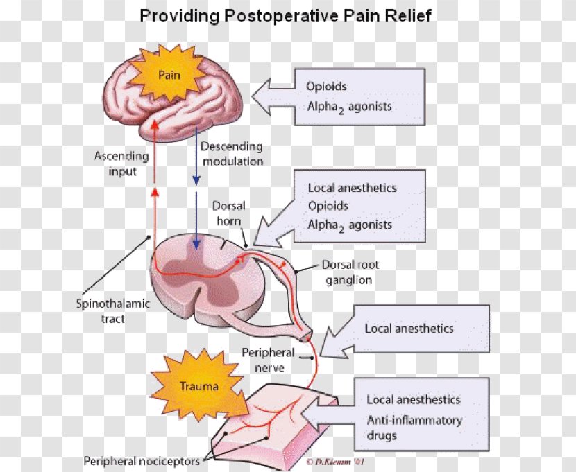 Acute Pain Management Chronic Analgesic - Cartoon - Anesthesiology Transparent PNG