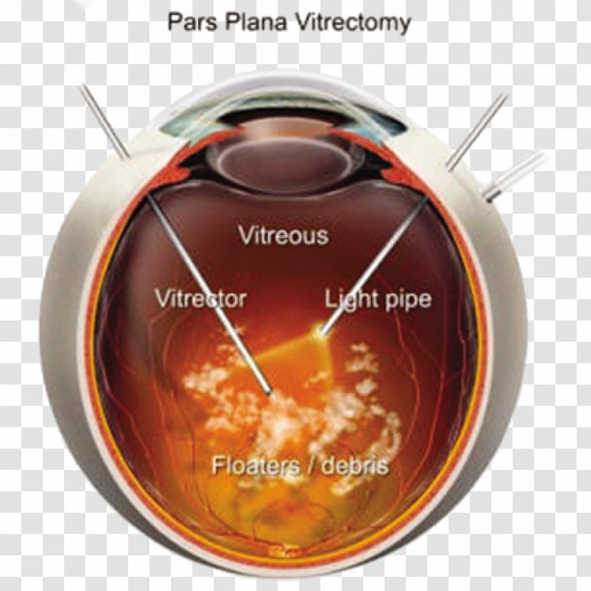 Diabetic Retinopathy Retina Vitreous Body Human Eye Laser - Alarm Clock Transparent PNG