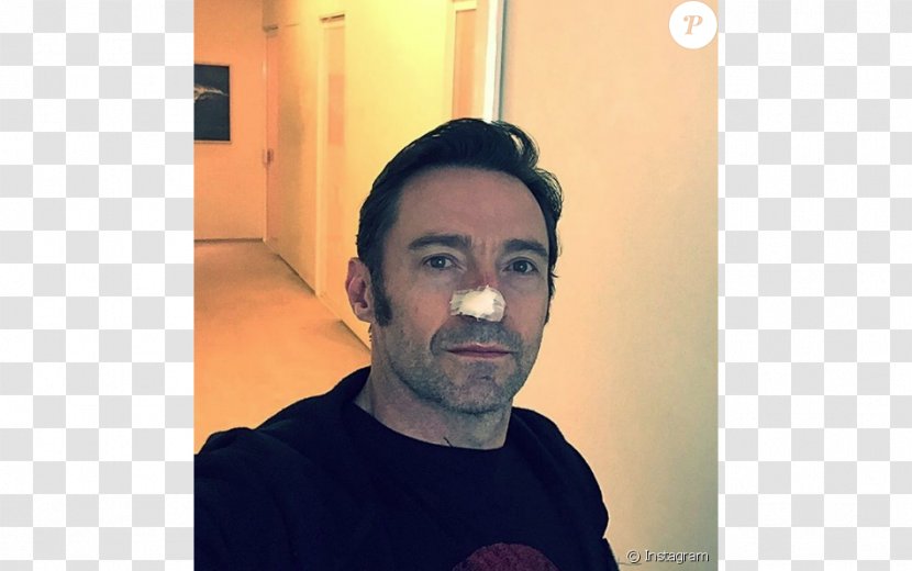 Hugh Jackman Skin Cancer Nose Surgery - Cheek Transparent PNG