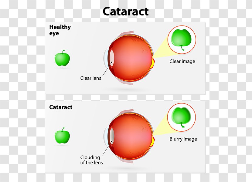 Cataract Surgery Intraocular Lens Human Eye Transparent PNG