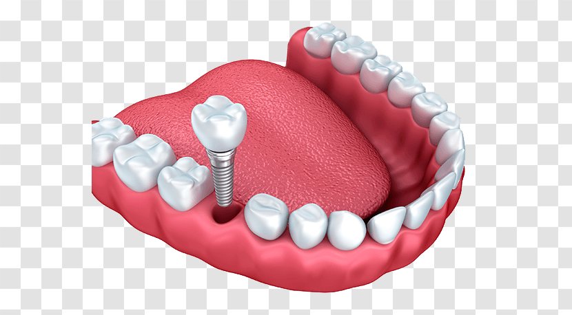 Dental Implant Dentistry Tooth - Permanent Teeth Transparent PNG