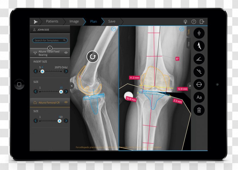 Brainlab Orthopedic Surgery Knee Replacement American Academy Of Orthopaedic Surgeons - Medical Transparent PNG
