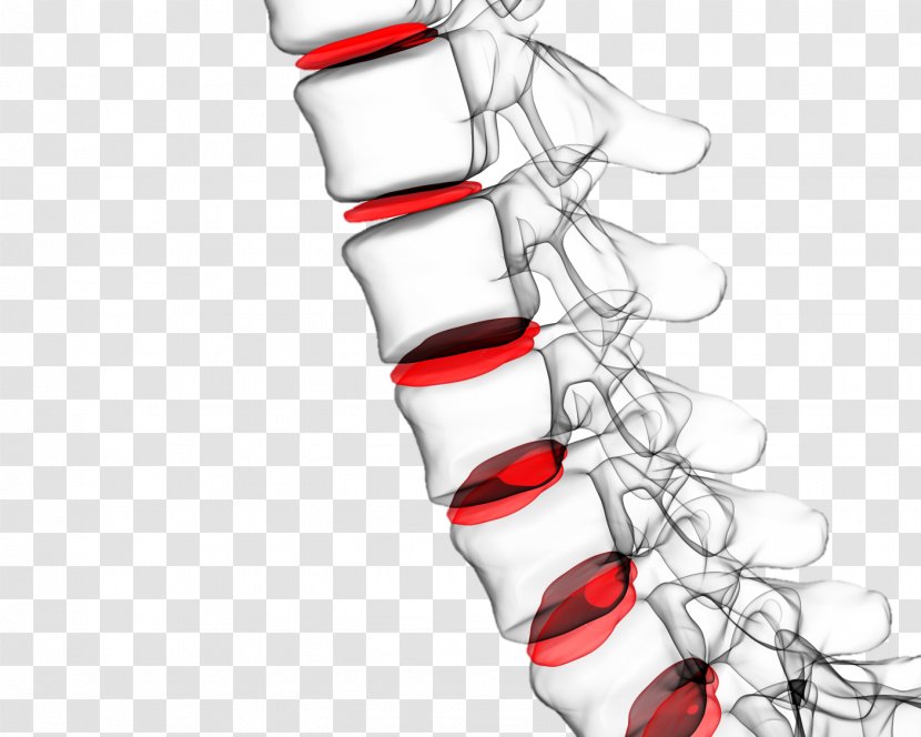 Vertebral Column Low Back Pain Spinal Disc Herniation Human - Intervertebral Arthroplasty - Fish Vivid Vision Transparent PNG