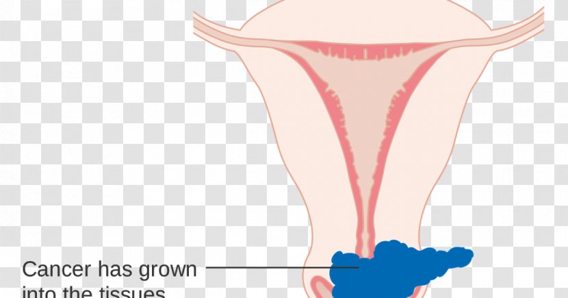 Cervical Cancer Staging Cervix - Watercolor - Cartoon Transparent PNG