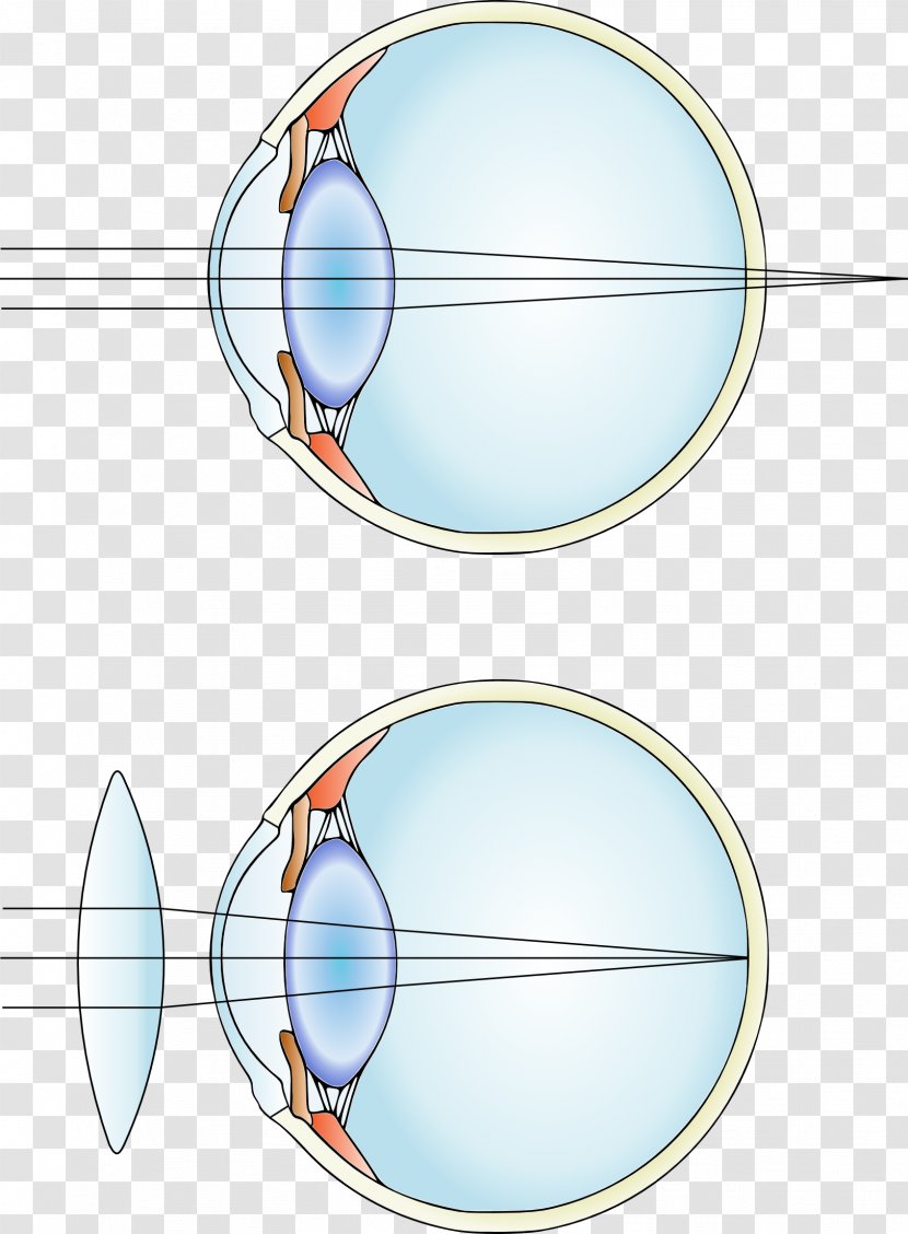 Near-sightedness Corrective Lens Hypermetropia Contact Lenses - Eye Transparent PNG