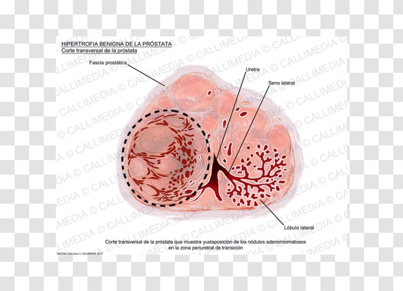 Benign Prostatic Hyperplasia Prostate Cancer Hypertrophy Benignity - Nodule - Gland Transparent PNG