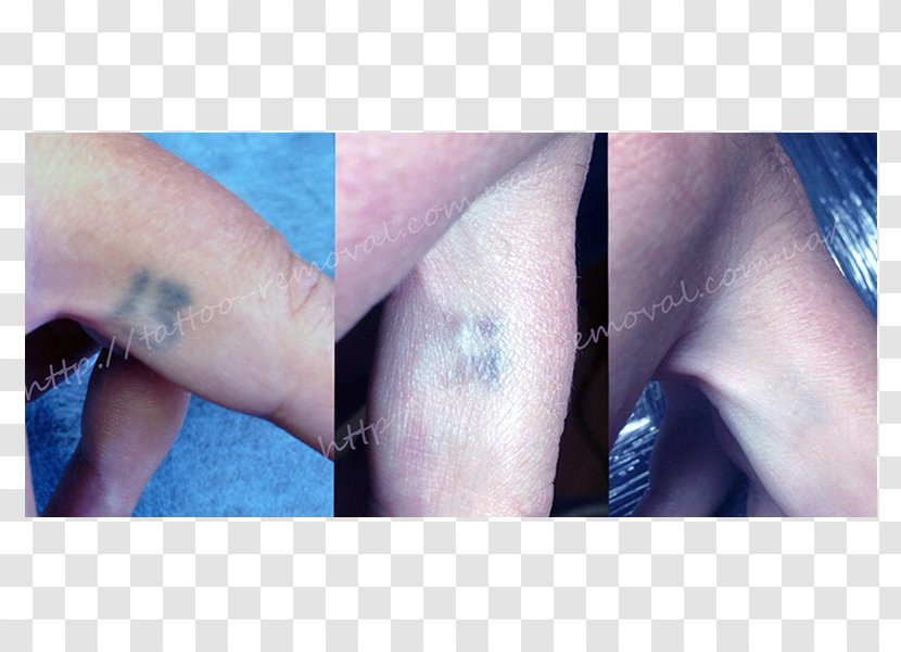 Tattoo Removal Permanent Makeup Scar Q-switching - Eyelash Transparent PNG