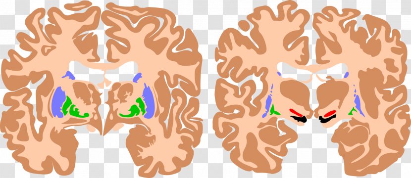 Basal Ganglia Brain Athetoid Cerebral Palsy Cortex - Silhouette Transparent PNG