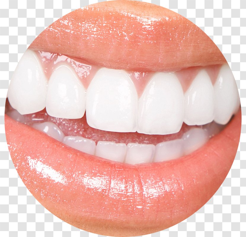 Veneer Cosmetic Dentistry Tooth Whitening - Human - Surgery Transparent PNG