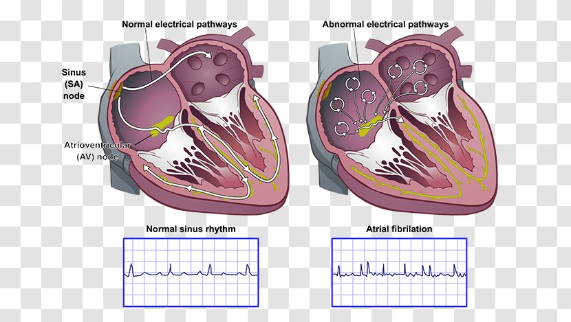 Heart Arrhythmia AV Nodal Reentrant Tachycardia Atrial Fibrillation Sinoatrial Node Atrium - Cartoon Transparent PNG