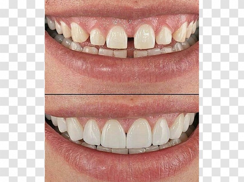 Tooth Veneer Dentistry Farza Optical - Dental Implant - Crown Transparent PNG