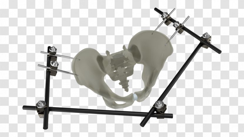 Pelvis Bone Fracture External Fixation Traction - Tree Transparent PNG