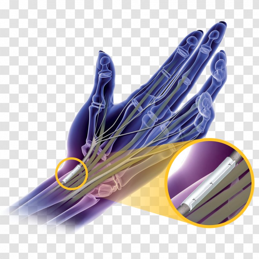 Carpal Tunnel Syndrome Surgery Nerve Hand - Electric Blue Transparent PNG