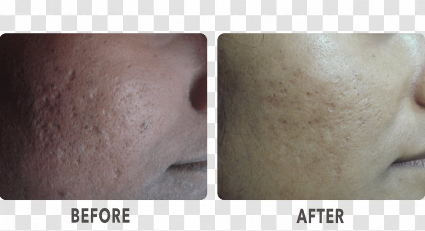 Chin Cheek La Skinnovita- Dr. Anuj Pall Dermatology, Laser & Hair Centre Forehead - Nose - Chicken Pox Transparent PNG